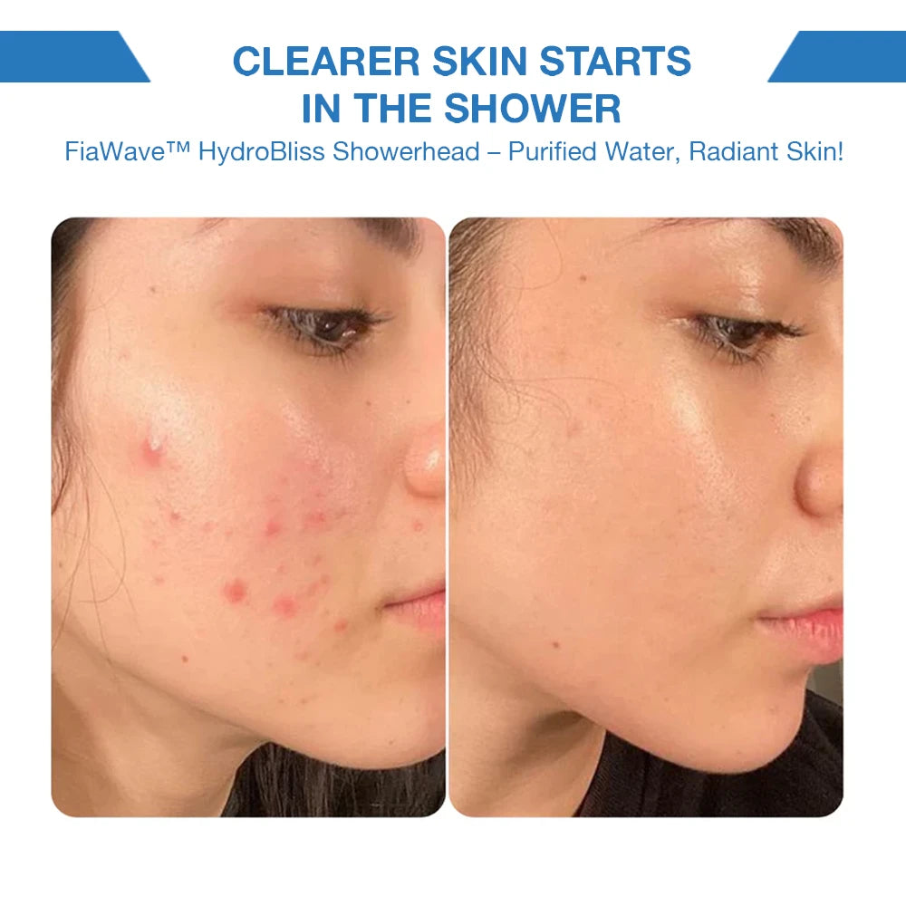 before and after skin transformation results. Left: acne-prone skin before use. Right: visibly clearer, smoother, and healthier skin after regular use with purified, filtered water. Helps reduce breakouts, irritation, and dryness.